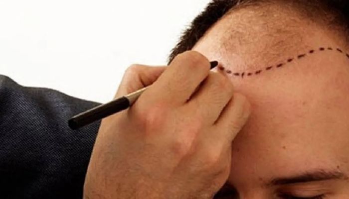 Türkiye’de saç ve estetik için ordudan 1 milyon sterlin çaldı