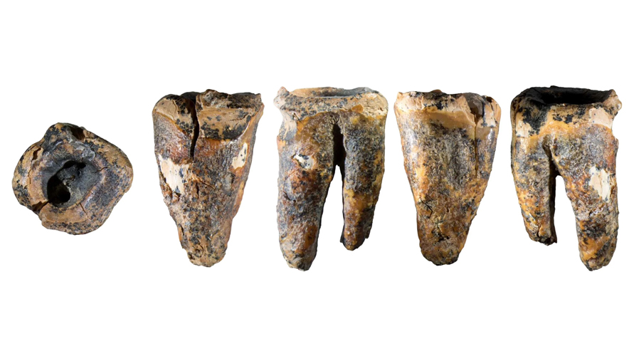 59 bin yıllık Neandertal dişi tarihin en eski diş tedavisini ortaya çıkardı